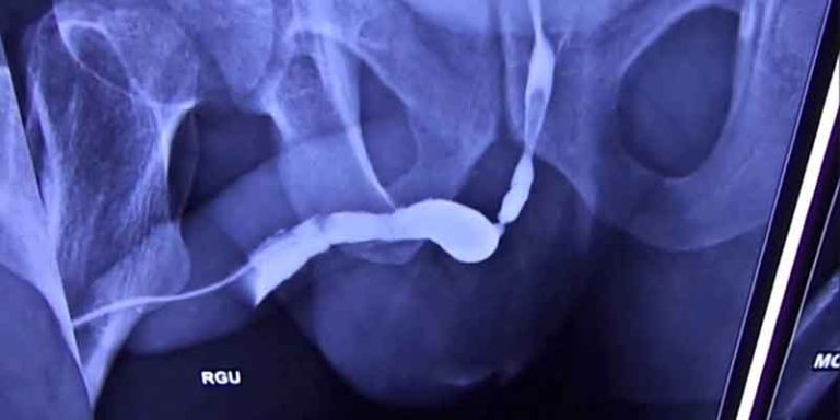 How Do You Know That You Have Urethral Stricture?