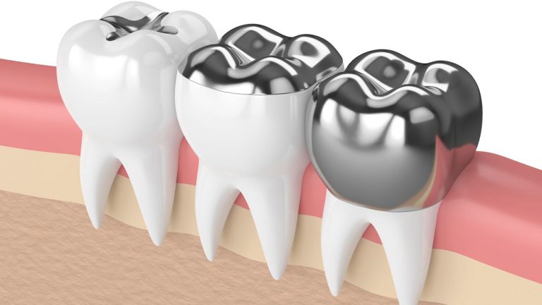 Stainless Steel Crowns Are Dental Heroes Of Durability