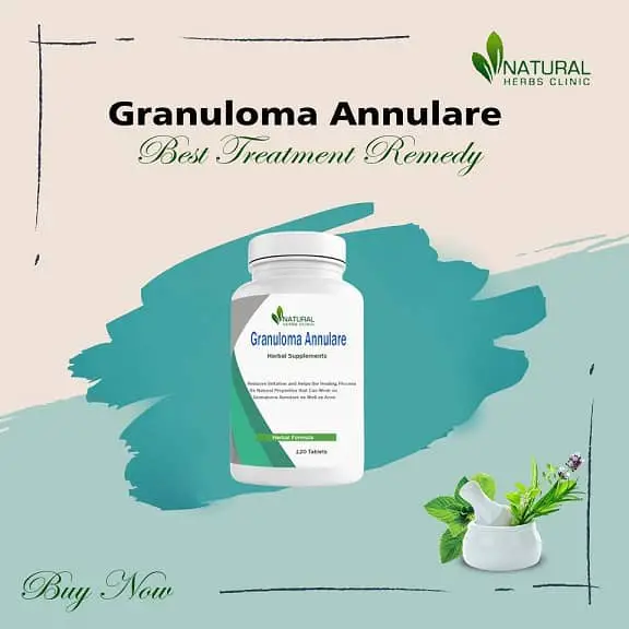 Granuloma Annulare Natural Herbal Remedies