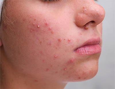 Holistic Approaches to Treating Acne: Mind-Body Solutions for Clearer Skin