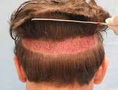 What is Hair Transplant surgery in Hindi ?