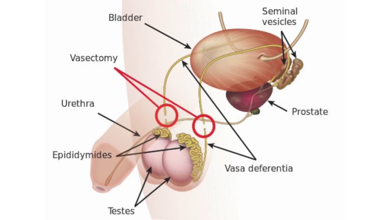 Valpo Vasectomy: A Comprehensive Guide to Safe and Effective Sterilization
