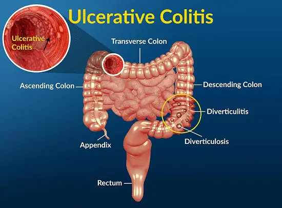 Comprehensive Ulcerative Colitis Treatment at Redding Gastroenterology: A Road to Relief