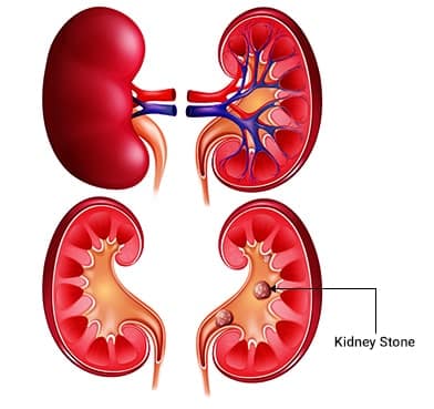 The Link Between Kidney Stones and Your Diet