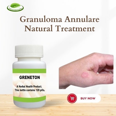 Natural Treatment for Granuloma Annulare