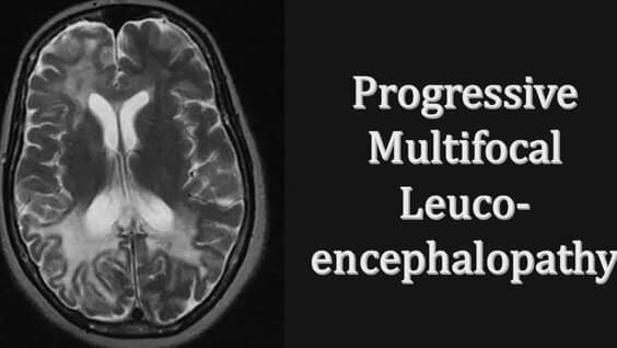 Progressive Multifocal Leukoencephalopathy Treatment Market