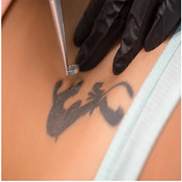 Removing tattoos with laser techniques: technologies and treatment phases