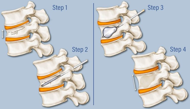 Vertebroplasty And Kyphoplasty Devices Market Size & Trends by 2032 | FMI