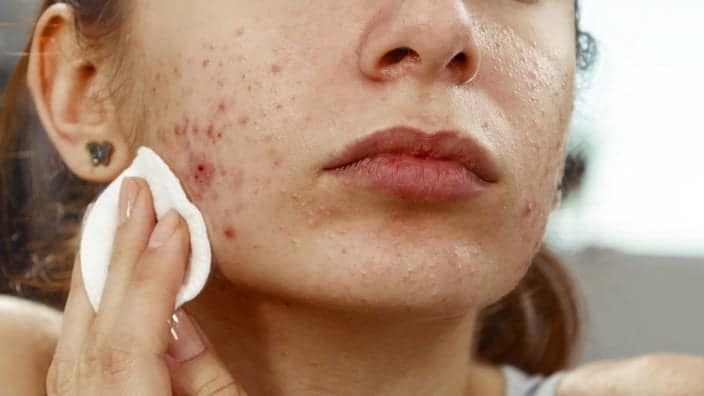 Skin Renewal in Dubai: Acne Scar Solutions Unveiled