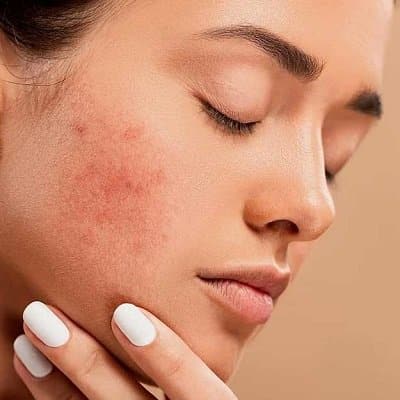 Express Lane to Clear Skin: Acne Treatment in Dubai Demystified