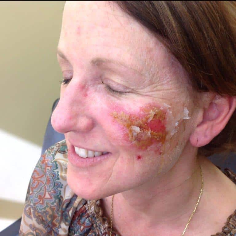 actinic keratosis