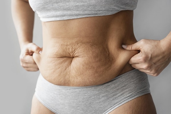 Stretch Marks: Common Causes and how to get rid of stretch marks