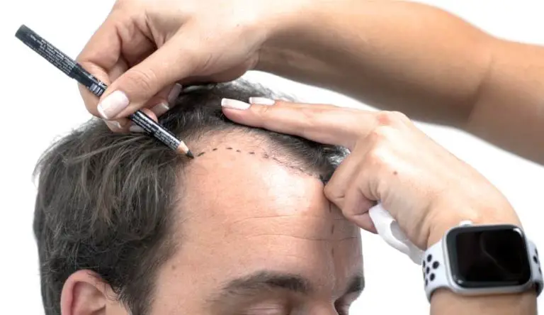 Reclaiming Confidence: An In-Depth Look at Hair Restoration in Islamabad