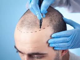 When to Use Hair Restoration With PRP?