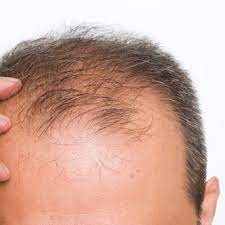 How is the Procedure Performed of Hair Transplant in Dubai ?