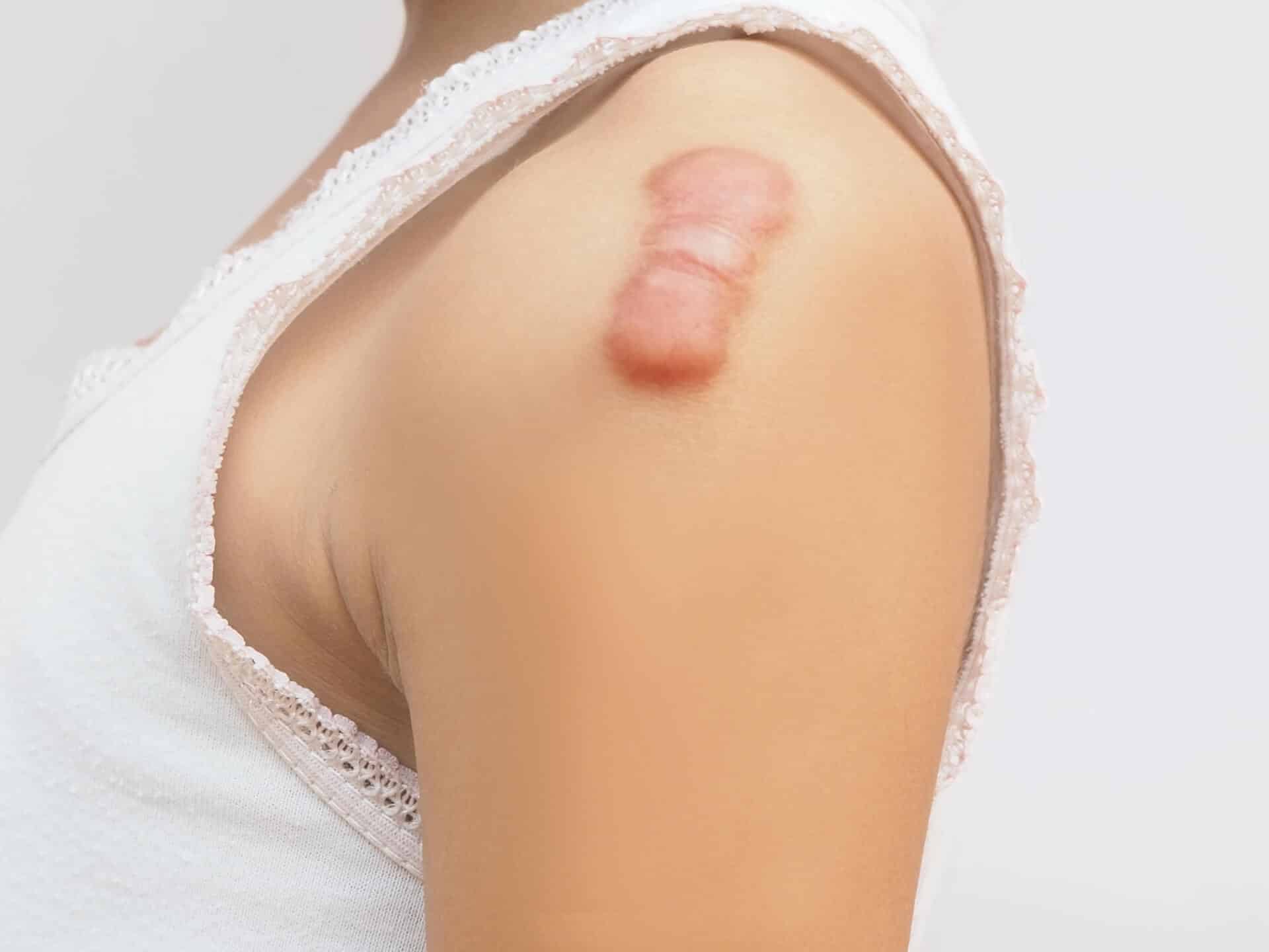 keloid scar