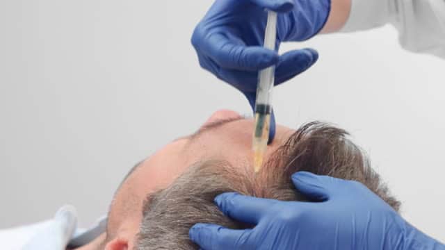 Renewing Confidence: Embarking on a Hair Restoration Journey with PRP Therapy in Islamabad