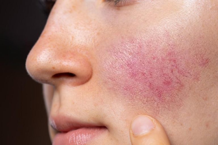 Renewed Radiance: Rosacea Treatment in Dubai