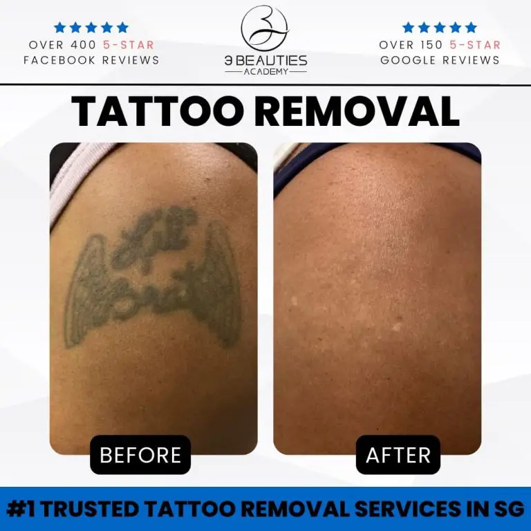 Discover Effective Tattoo Removal Solutions at Our Clinic!