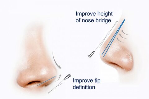 What Is a Nose Thread Lift or String Rhinoplasty?