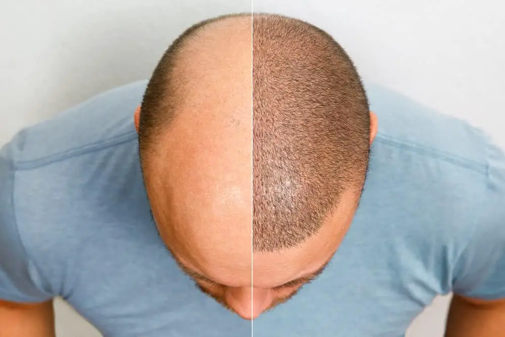 How-Much-Does-Hair-Transplant-Cost-In-LA