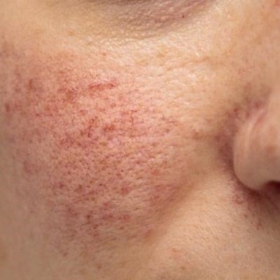 Achieve Clearer Skin: Unveiling Effective Rosacea Treatments