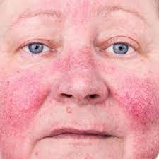 Comprehensive Treatment for Actinic Keratosis in Dubai