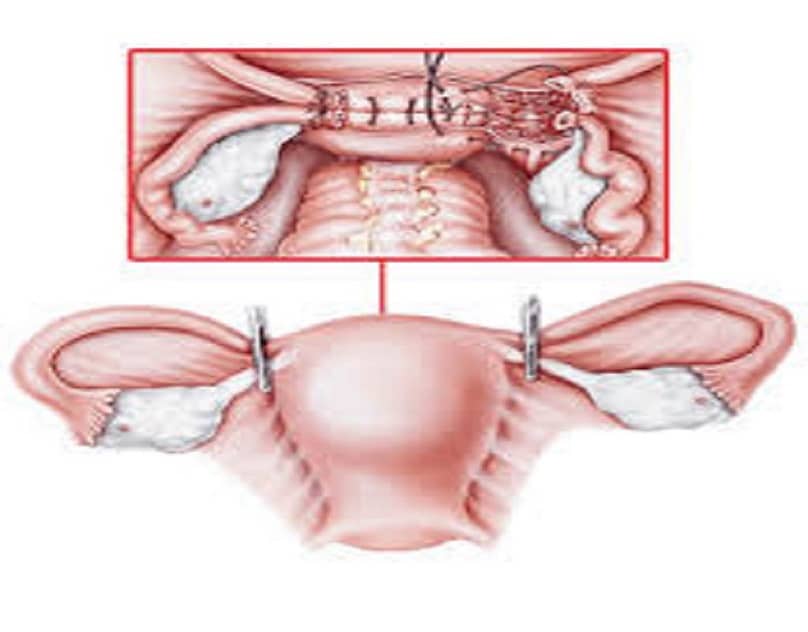 hysterectomy