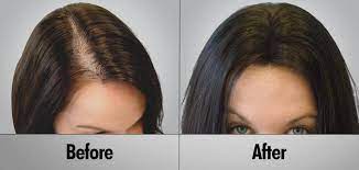 Hair Transplant Cost & UAE ?