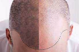 Body Hair Transplantation in the Field of Hair Restoration