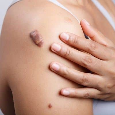 Keloid Treatment Costs in Dubai: What You Need to Know