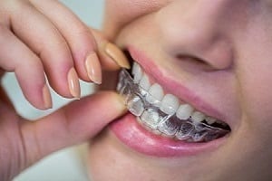 The Step-by-Step Process of Getting Invisalign The Colony TX