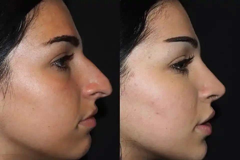 Before-After-best-nose-job-clini