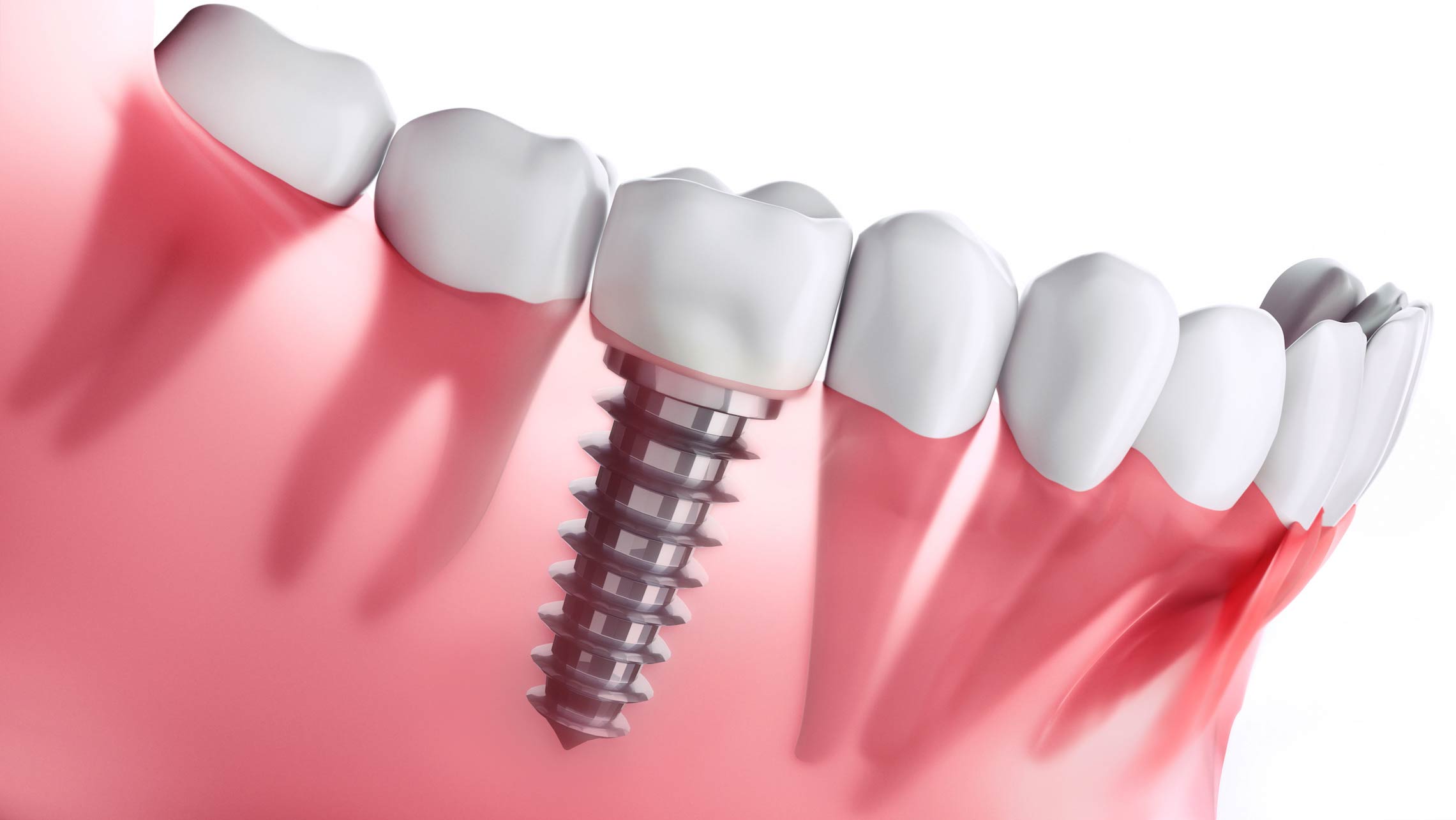 DentalImplants