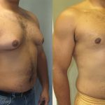 Patient Selection for Gynecomastia Surgery - TheOmniBuzz
