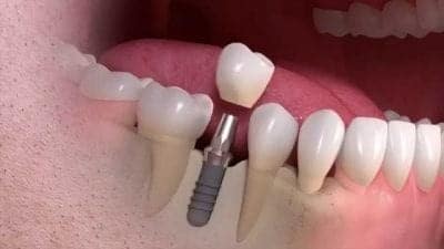 How Long Does It Take to Get a Single Dental Implant?
