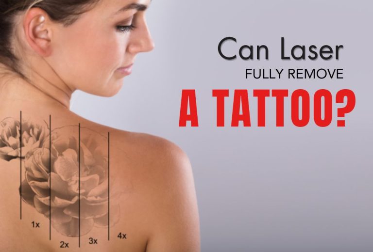 Does Laser completely remove tattoos?