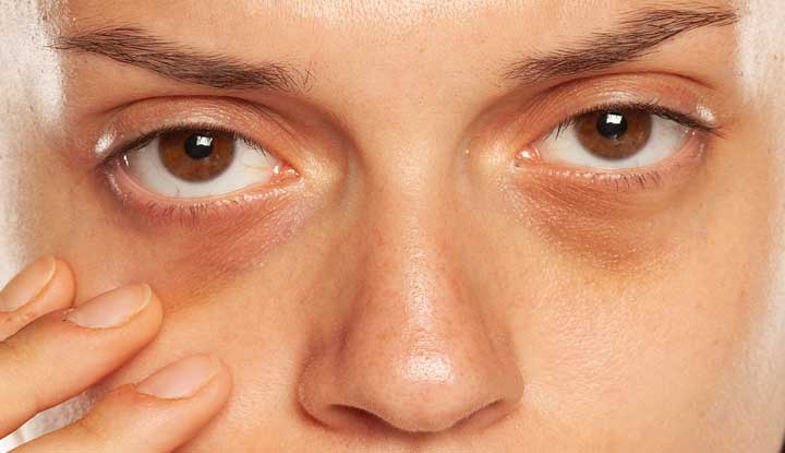 Say Farewell to Dark Circles: Dubai’s Best Treatments