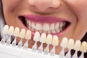 Dispelling Myths about Porcelain Veneers The Colony Limitations