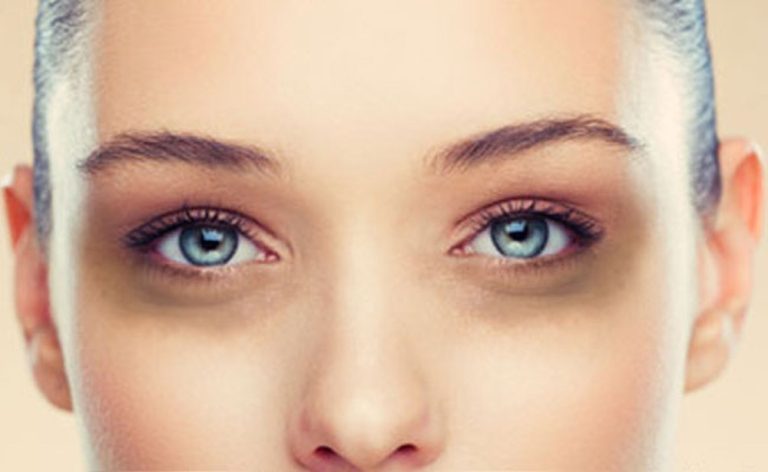Dark Circle Treatment with Fillers