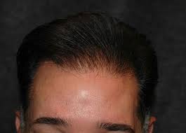 Hair Transplant