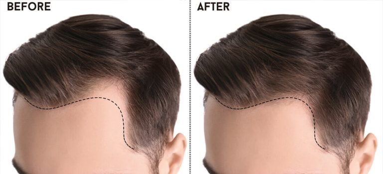 Hair Restoration in the City of Gardens: A Guide to Hair Transplants in Islamabad