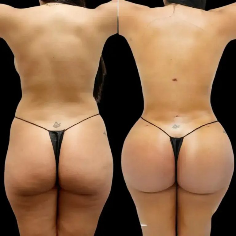 How to Choose the Right Type of Brazilian Butt Lift for You in Dubai