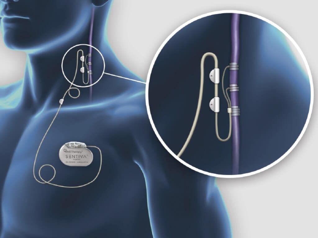 Global Vagus Nerve Stimulator Industry