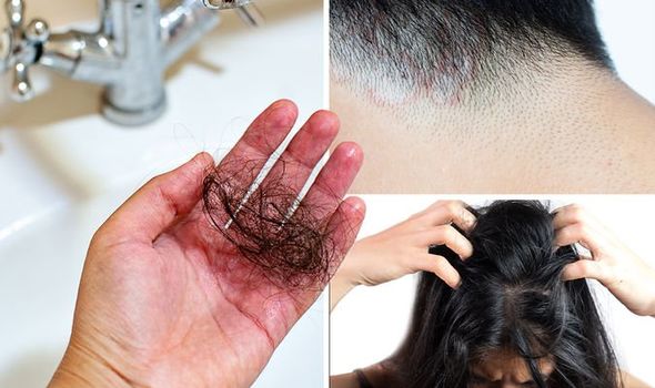 Hair-loss-Do-you-have-tinea-capitis-1397485