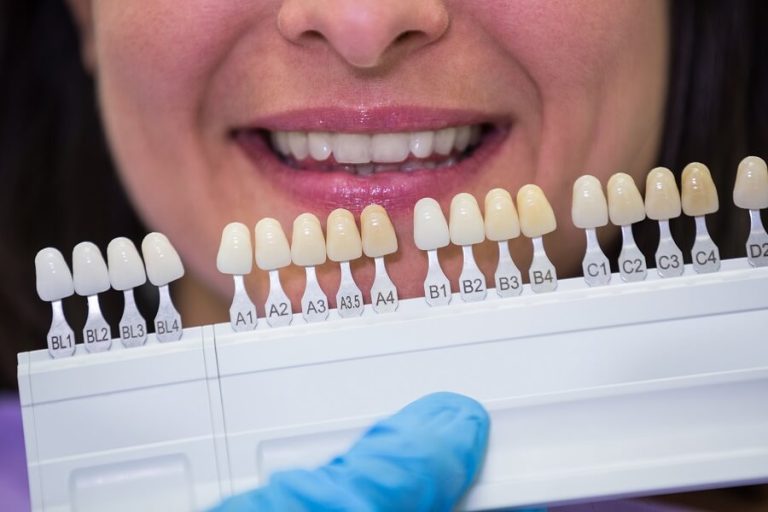 Porcelain Veneers in Dallas: Enhancing Confidence One Smile at a Time