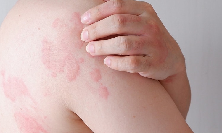 Dubai’s Perspective on Skin Allergies: Diagnosis and Treatment