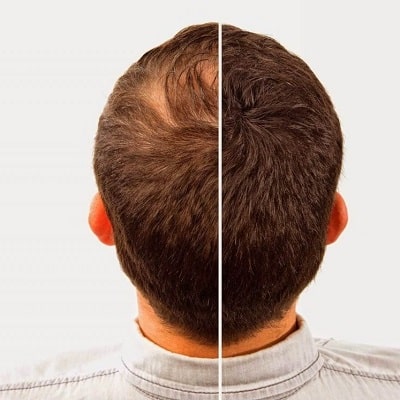 FUE vs. FUT Hair Transplant in Lahore – Advantages