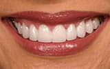 Zoom teeth whitening in the colony