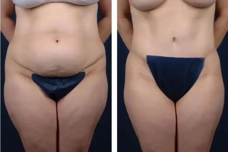 Who is a Good Candidate for a Belly Tuck?